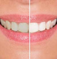 Teeth Whitening By Dr. Sindhu Gundabathula, DDS Dentist near Doylestown, Pennsylvania