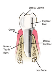 Dental tooth implants in Doylestown, Pennsylvania